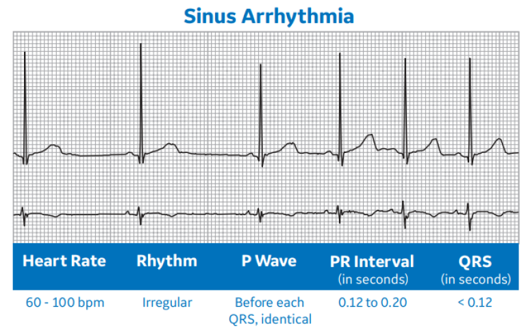 Sinus Arrhythmia