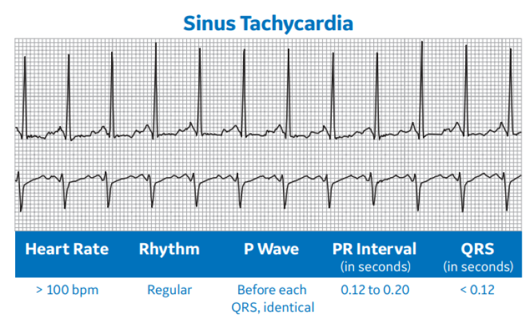 Sinus Tachycardia