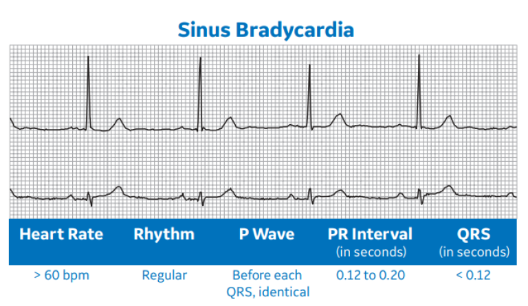 Sinus Bradycardia