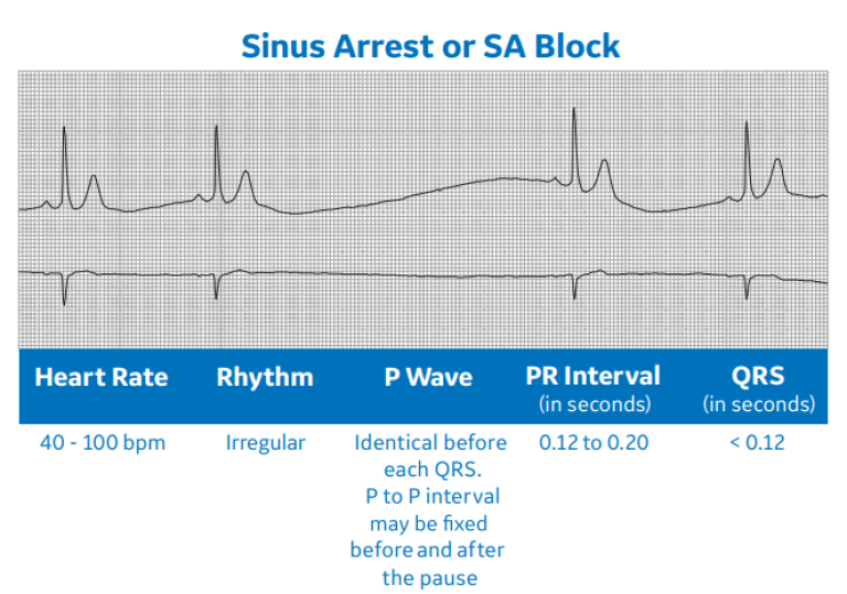 Sinus Arrest or SA Block
