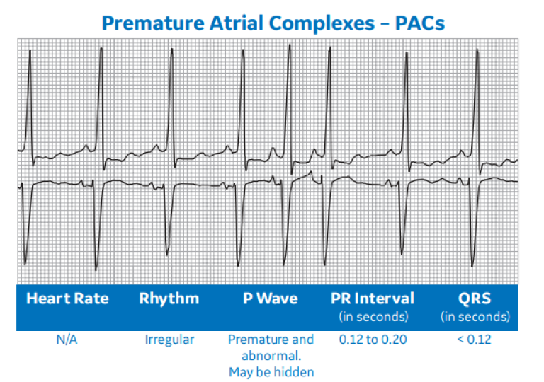 Premature Atrial Complexes - PACs