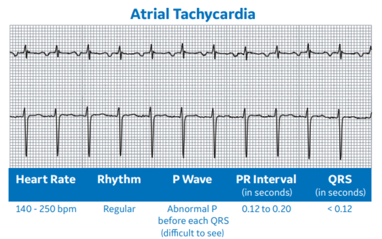 Atrial Tachycardia