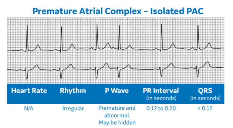Premature Atrial Complex - Isolated PAC