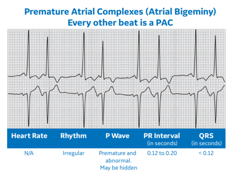 Premature Atrial Complexes (Atrial Bigeminy)