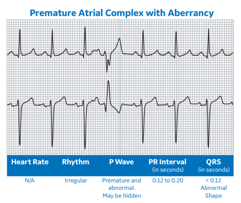 Premature Atrial Complex with Aberrancy