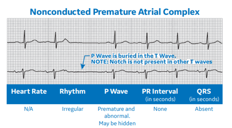 Nonconducted Premature Atrial Complex