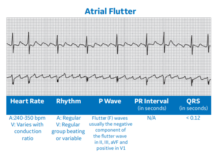 Atrial Flutter