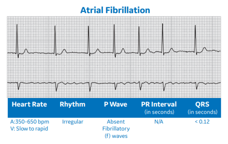 Atrial Fibrillation