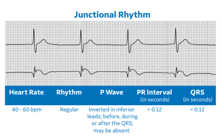 Junctional Rhythm