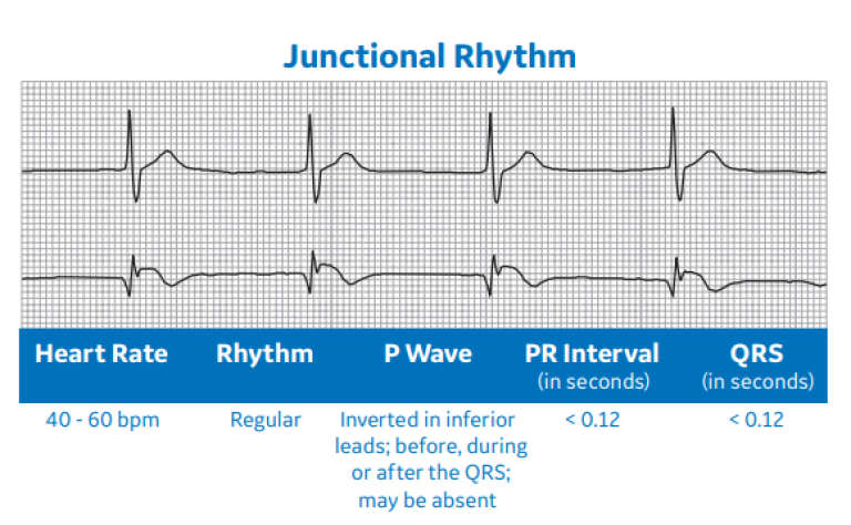 Arrhythmia Recognition Part 1 | Clinical View