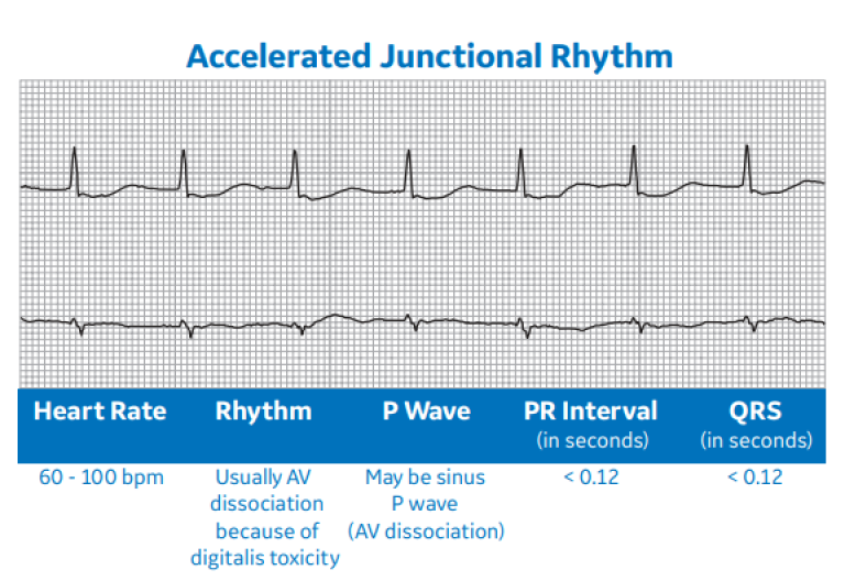 Accelerated Junctional Rhythm