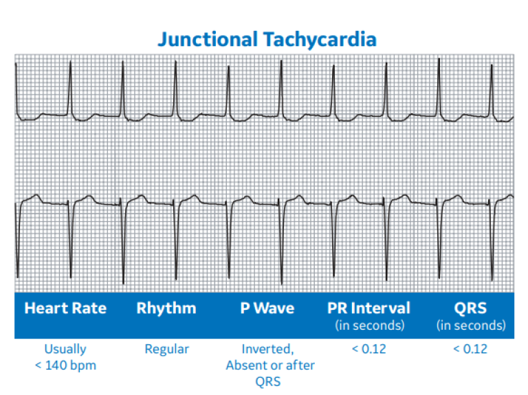 Junctional Tachycardia