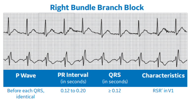 Right Bundle Branch Block
