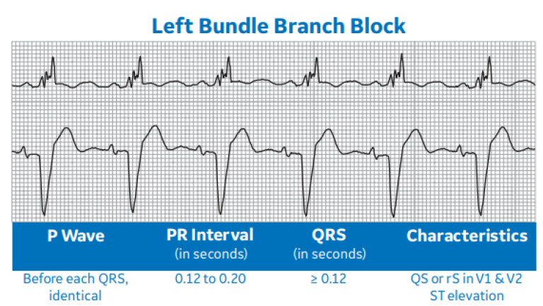 Left Bundle Branch Block