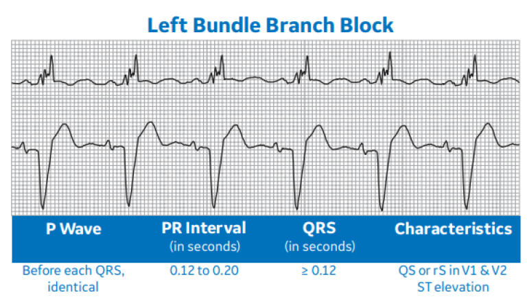 Arrhythmia Recognition Part 1 | Clinical View