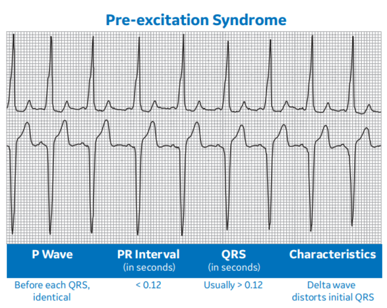 Pre-excitation Syndrome