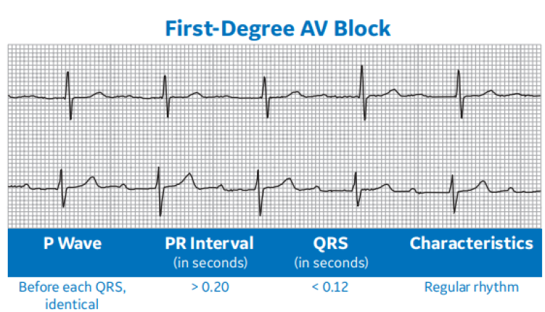 First-Degree AV Block