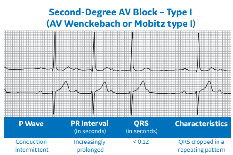 Second-Degree AV Block – Type I (AV Wenckebach or Mobitz type I)
