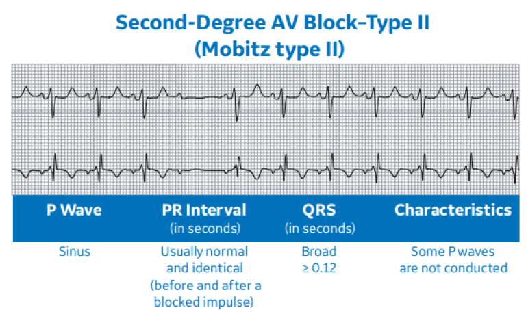 Second-Degree AV Block – Type II (Mobitz type II)