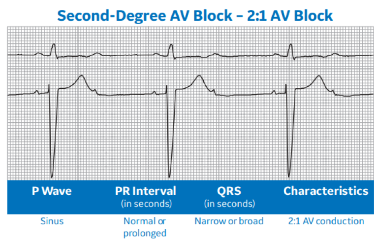 Second-Degree AV Block - 2:1 AV Block