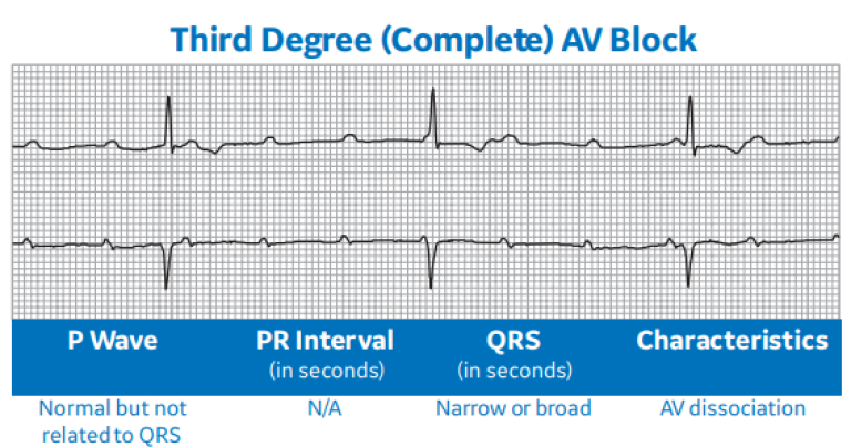 Third Degree (Complete) AV Block