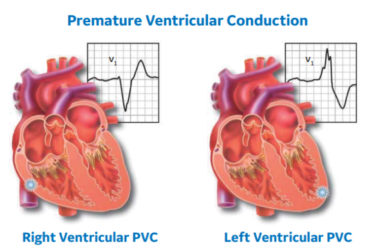Premature Ventricular Conduction