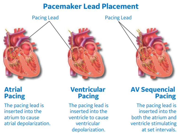Pacemaker Lead Placement