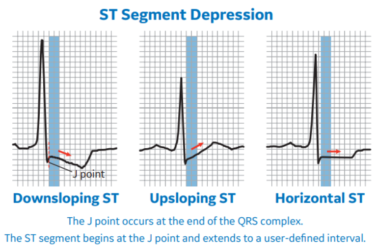 ST Segment Depression