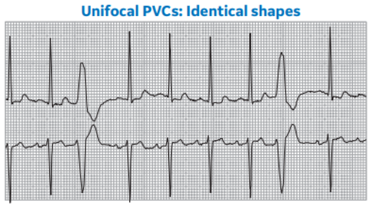 Unifocal PVCs: Identical Shapes