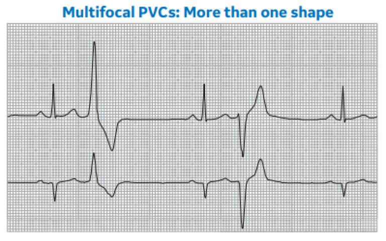 Multifocal PVCs: More than one shape