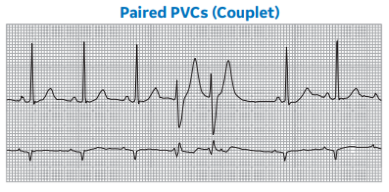 Paired PVCs (Couplet)
