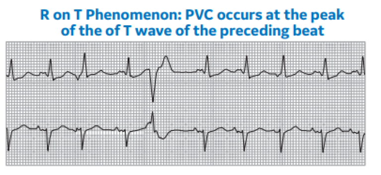 R on T Phenomenon: PVC occurs at the peak of the T wave of the preceding beat