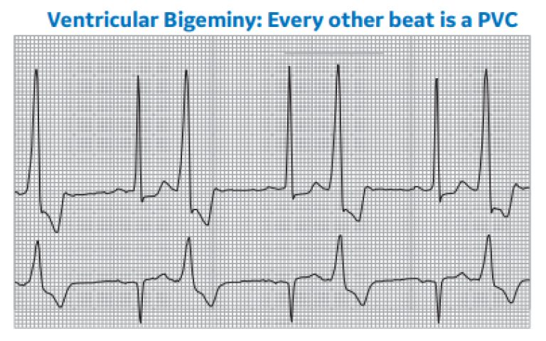 Ventricular Bigeminy: Every other beat is a PVC