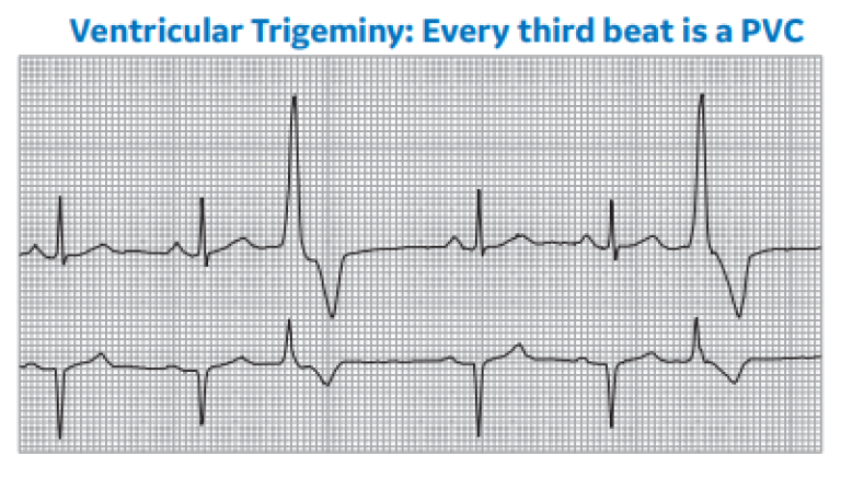 Ventricular Trigeminy: Every third beat is a PVC