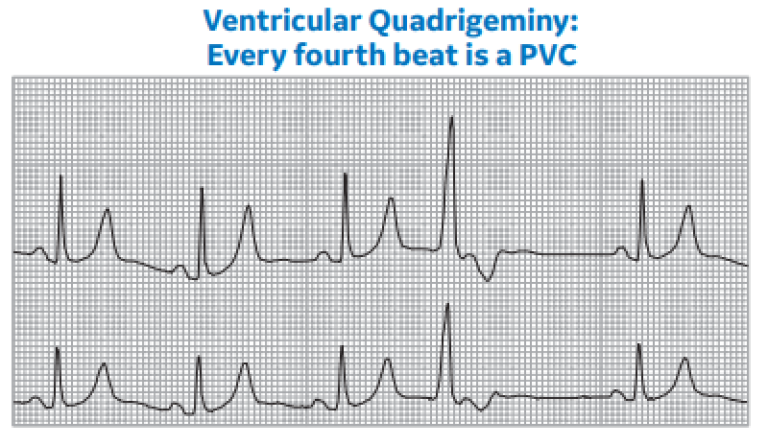 Ventricular Quadrigeminy: Every fourth beat is a PVC