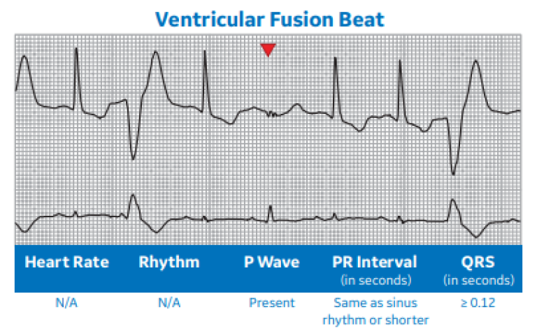 Ventricular Fusion Beat