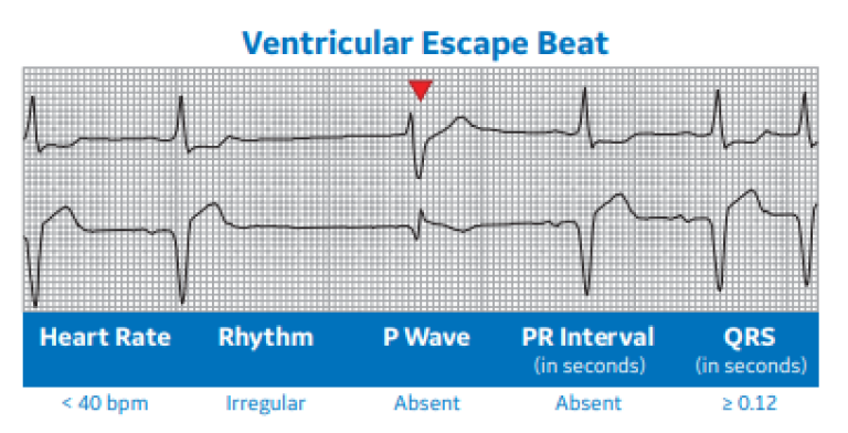 Ventricular Escape Beat