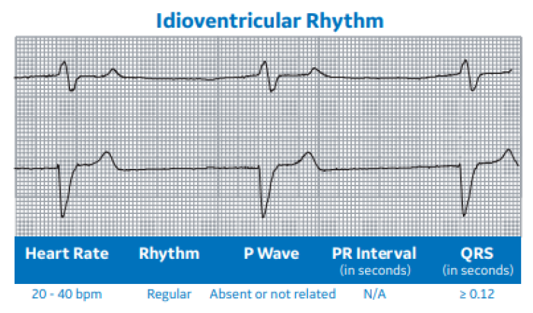 Idioventricular Rhythm