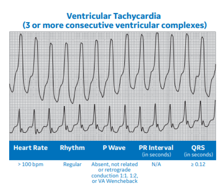 Ventricular Tachycardia (3 or more consecutive ventricular complexes)