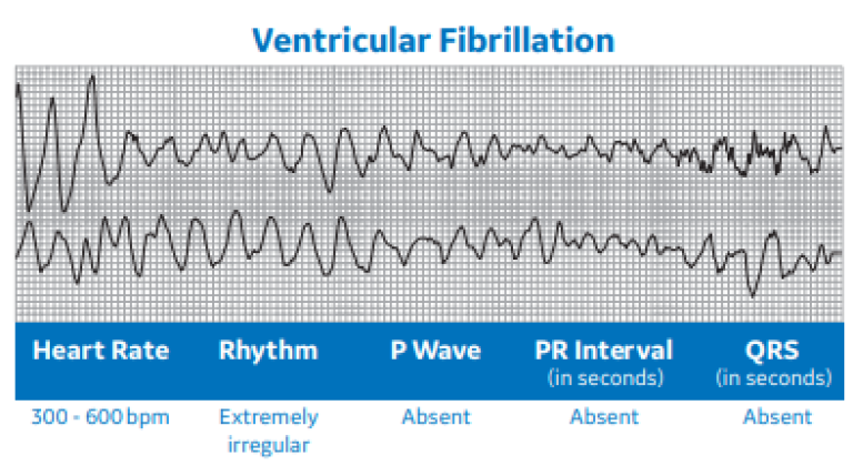 Ventricular Fibrillation
