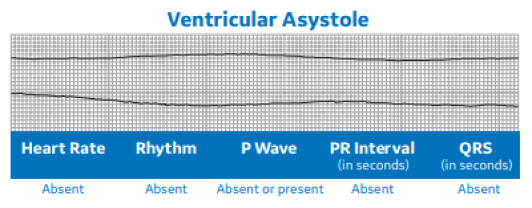 Ventricular Asystole