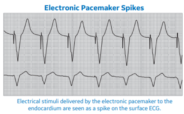 Electronic Pacemaker Spikes