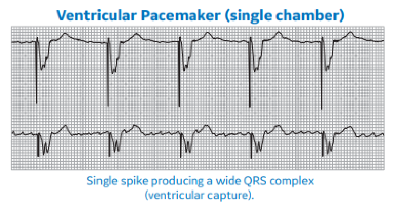 Ventricular Pacemaker (single chamber)