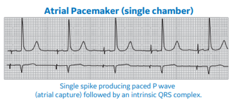 Atrial Pacemaker (single chamber)