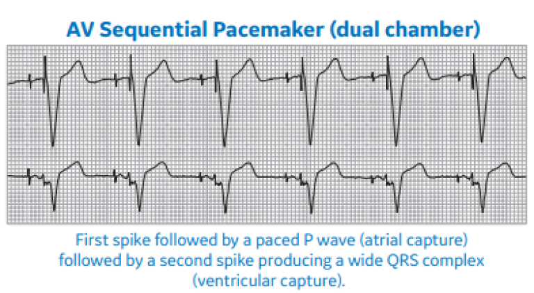AV Sequential Pacemaker (dual chamber)
