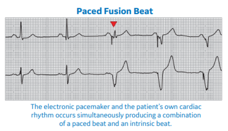 Paced Fusion Beat