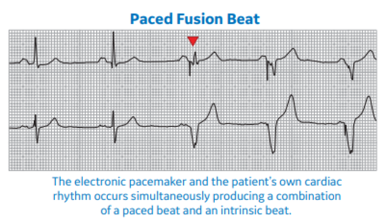 Arrhythmia Recognition Part 2 Clinical View