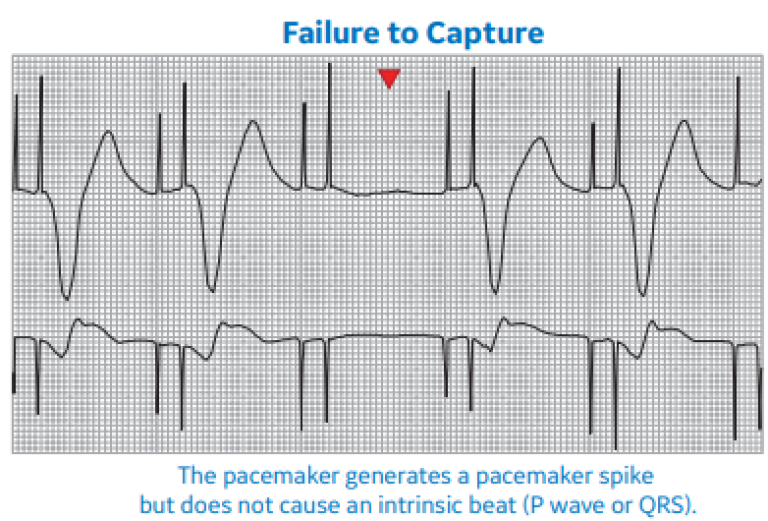 Failure to Capture