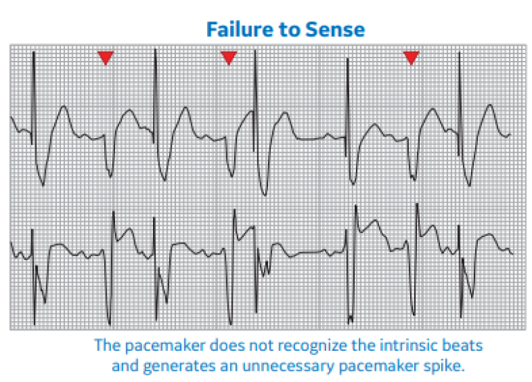 Failure to Sense