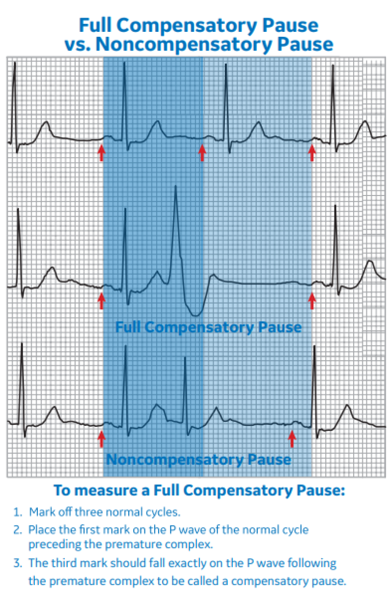 Full Compensatory Pause vs. Noncompensatory Pause
